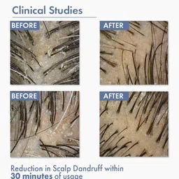 ThriveCo Anti-Dandruff Pre-Shampoo Serum for Itchy, Dry & Flaky Scalp | With Octopirox, Pentavitin & Arginine | Reduces Hair Breakage & Strengthens Hair for Men & Women | 10ml image 5