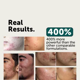 LAURITZ 10% Potassium Azeloyl Diglycinate Acne Control Serum- 30 ml image 3