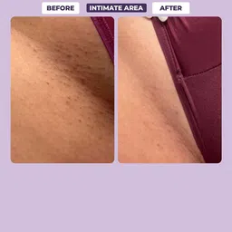 Sanfe Set Of 2 Spotlite Sensitive Areas Lightening Serum - 50 ml Each image 2