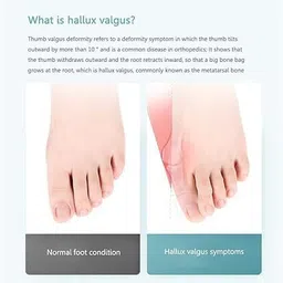 black mirror Toe straightener Bunion Splint Corrector wth Silicon GelPad toe fracture support image 4