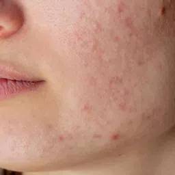 Nuerma Science Tea Tree Essential Oil - 15ml image 2