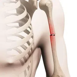 iglasa Large Size Humeral Brace Humeral Bone Fracture support Men & Women Hand Support image 4