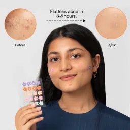 Gush Beauty Dart It Pimple Patches Work in 6-8 Hrs For Acne, Zits And Blemishes - Super Star (5 Colors) image 2