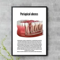 Periapical Abcess StatusRing Dental Poster without frame-picture-20