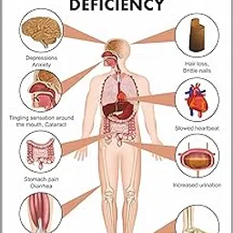 Anne Print Solutions Calcium Deficiency Poster for Hospital, Nursing Home, Clinic (Size 13X19 Inch, Printed on Non-Tearable Imported Sheet) image 1