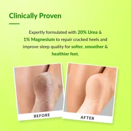 Fixderma Foobetik 20% Urea Foot Roll On For Dry & Cracked Heels with 5% Lactic Acid & 1% Magnesium | Dermatologically Tested | Helps Repair and Moisturise Cracked Heels - 60ml image 5