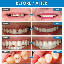 Snap-On Instant Perfect Smile Veneers Comfortable Flex Fit Dentures for Top & Bottom| Tooth Cosmetic Cover Comfort Fit Flex Dentures for White Neat Smile image 2