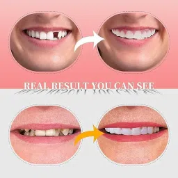 Snap-On Instant Perfect Smile Veneers Comfortable Flex Fit Dentures for Top & Bottom| Tooth Cosmetic Cover Comfort Fit Flex Dentures for White Neat Smile image 1