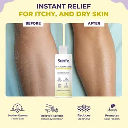Sanfe Eczema Lotion With Shea Butter & Glycerin - 100 ml image 4