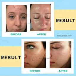 AARADHYAM Derma Roller For Acne image 5