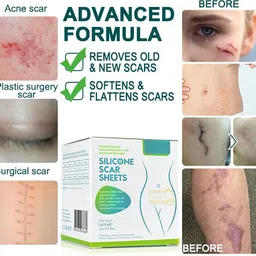 zmeet Medical Soft Silicone Gel Tape for Scar Removal Inhaler image 5