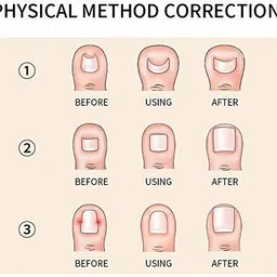 digital shoppy Ingrown Toenail Correction Tool with CASE | Feet Toe Nail Pedicure Corrector Lifter Fixer Toe Nail Straightener Tool-Pack of 2 image 5