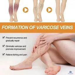 aeyurbs Varicose Vein Relief Spray | Helps Restore Relaxed Feeling Liquid image 2