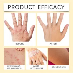 ACTIWOW Vitigo Bee Venom Cream for Moisture Lock image 5