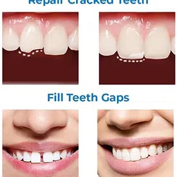 qorelya Temporary Tooth Replacement Kit Simple Dental Repair at Home Teeth Whitening Liquid image 2