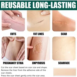 silicon scar Silicone Scar Sheets For Strech MArcks Removal, Tummy Tunk Crepe Bandage image 3