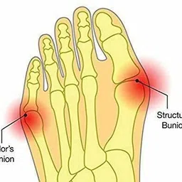 erinshop Toe Separators Ring for Overlapping Big Toes, Bunions, Alignment, Spacers image 4