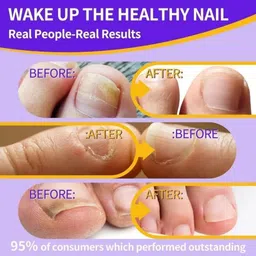 actiwow Fungi-Free Non-Toxic Nail Healing Solution image 4