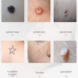 relifa Relifa™ LCD Screen Display Beauty Mole Removal Sweep Spot Pen Painless Spot Mole Tattoo Wart Speckle Remover Pen Beauty Portable Care Equipment(Multicolor) image 5