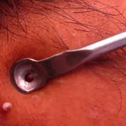 Lemixco Pimple, Acne And Blackhead Remover Tool image 5