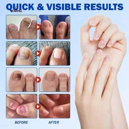 lorshel Fungal Nail Patches : fungal toenail treatment patch & nail fungus patch trea... Nail Sanding Pad image 4