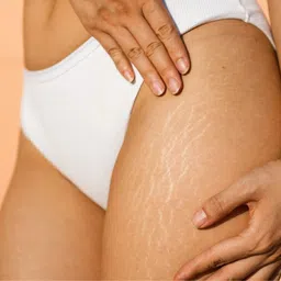 fraileno Stretch Marks Oil to Reduce & Skin Toning Stretch Mark Removal Oil image 4