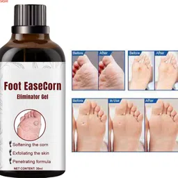 ayyiashi Safe Corn Remover 30ml Effective Daily Use Foot Care Solution image 1