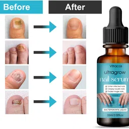 vitracos Ultragrow Nail Serum for Fungal Infection & Growth Blue-picture-12