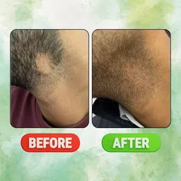 shlazio Alopecia Hair Regrowth Roll On for Scalp, Beard Patches (Pack of 1) image 5