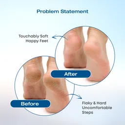 beaulook 20% Urea Foot Cream Roll-On, For Dry & Cracked Heel, Moisturizes & Repair Feet image 2