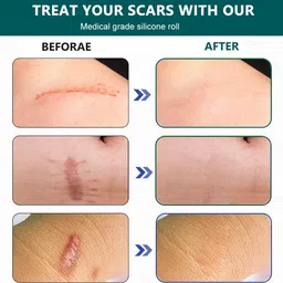 gopinath autolink 4pcs Waterproof Silicone Scars Removal Sheets Sticker For Constitution Tissue Crepe Bandage image 3