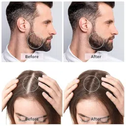 PACK OF 2 Roller P-2 For Hair And Beard Regrowth 540 Micro 1mm Titanium Needles Reduces Hair Fall & Stimulates Hair Follicles, Safe and Effective Easy to use | Skin Care Men and Women image 5