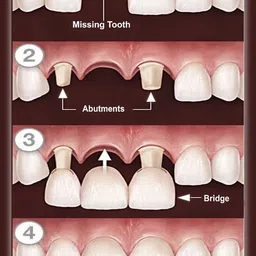 mahalaxmi Poster Dental Doctor Bridge Of Tooth Wall Poster (300 Gsm Matte Paper, 13 X 19 Inch, Multicolour) Fine Art Print image 1